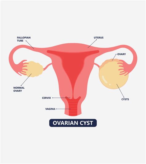 Ovarian Cysts During Pregnancy Types Symptoms And Treatments