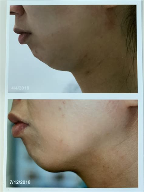 We did not find results for: how to get rid of double chin - Dermatology & Laser ...