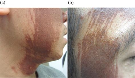 Erythema And Hyperpigmentation Four Days Following 50 Tca Application