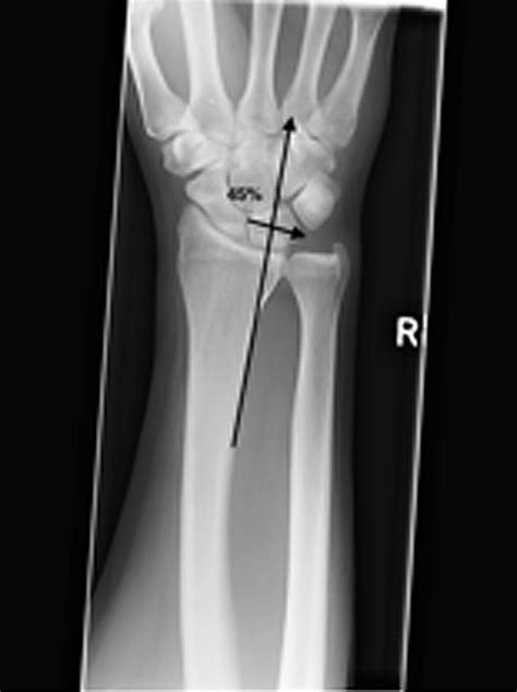 Residual Radial Translation Of Distal Radius Fractures—defining A New
