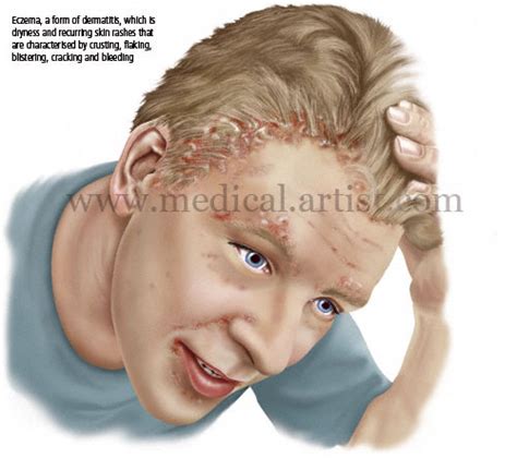 Medical Illustrations Of Eczema Dermatitis Illustrations Stages Of