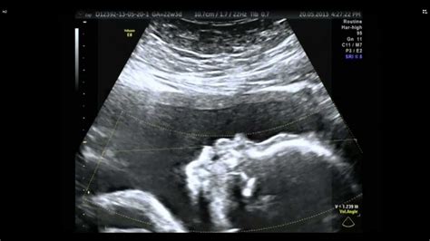 Pleural Effusion Fetal Ultrasound