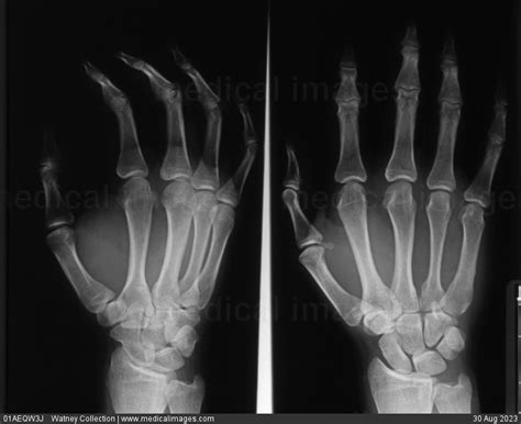 Stock Image X Rays Of The Normal Hand And Wrist Posterior Anterior And