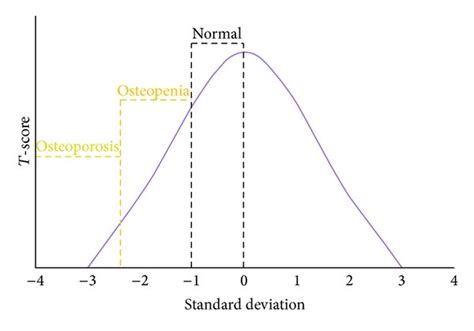 Standard Distribution Of T Score Based On Dexa Standard Outcomes