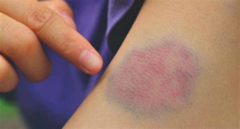 Bruise Itch And Its Causes Mbbch Health Encyclopedia