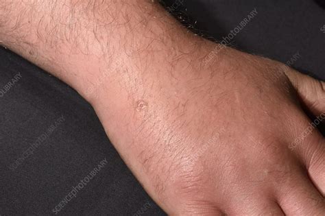 Allergic Reaction To Insect Bite Stock Image C0498263 Science