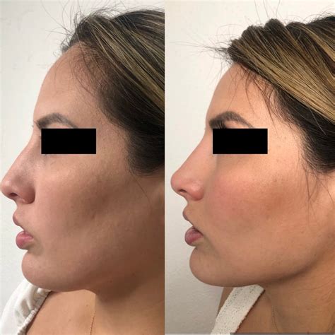 Armonización Facial Cdmx Aesthetic Doctors Mexico
