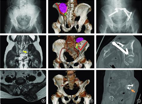 Osteosarcoma In The Ilium Of A 56 Year Old Male A Plain Radiograph