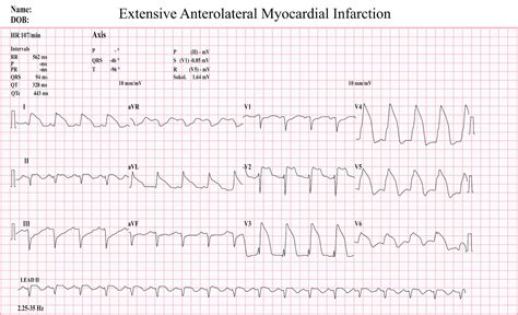 Anterolateral Acute Myocardial Infarction Ecg