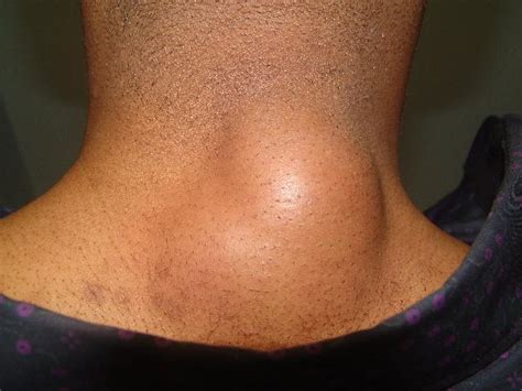 Lumps And Bumps At Back Or Side Of Neck Small Large Soft Hard
