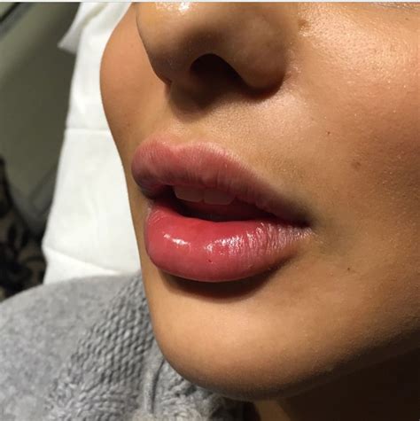 Perfect Lip Fillers Perfect Lips Lip Fillers Lip Injections