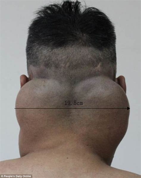 Chinese Alcoholic Develops Fat Deposits Around His Throat After