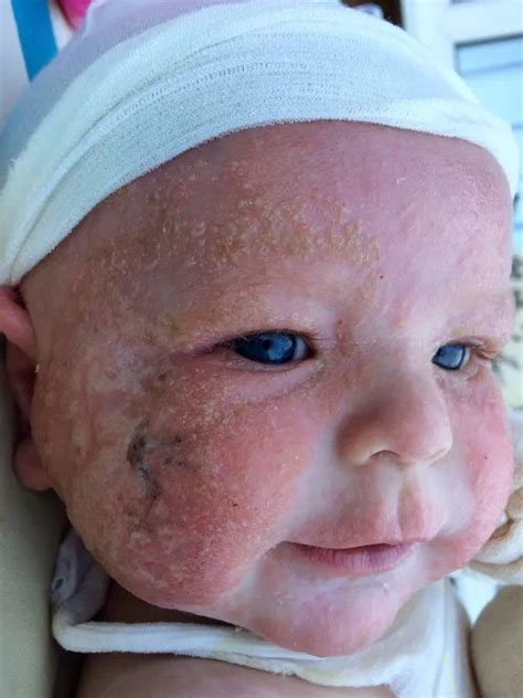Babys Eczema Was So Extreme That His Mum Couldnt Give Him A Cuddle