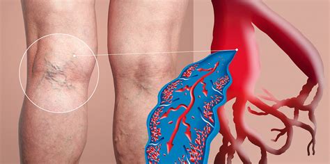 How To Know If You Have Deep Vein Thrombosis Dvt Beaumont Emergency