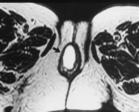 Practical Mr Imaging Of Female Pelvic Floor Weakness Radiographics