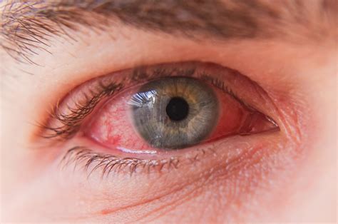 Jak Rozpozna Zapalenie Spoj Wek Objawy Leczenie Krople Do Oczu Hot My