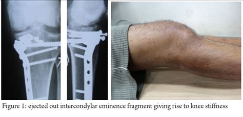 Fixation Of Inter Condylar Eminence Fragment In Bi Condylar Tibial