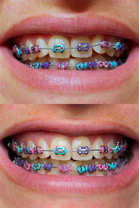 purple pink blue dientes con brackets brackets dentales ligas para brackets