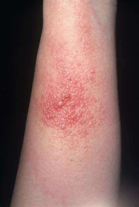 What Does Rash From Poison Oak Look Like