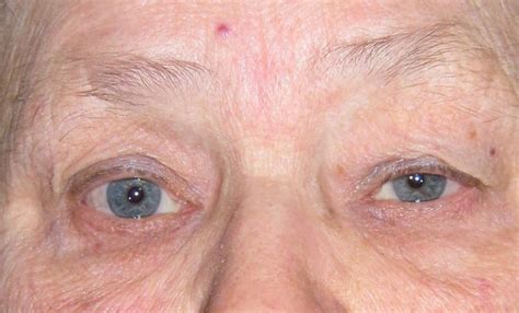 Correction Of Bilateral Drooping Upper Eyelids Ptosis Before Nissman Eye