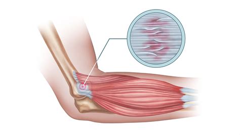Tennis elbow can be caused by trauma to the elbow or more often by repeated stress on the elbow tendons such as from sports or use of certain tools. Tennis Elbow Treatment | Franciscan Health