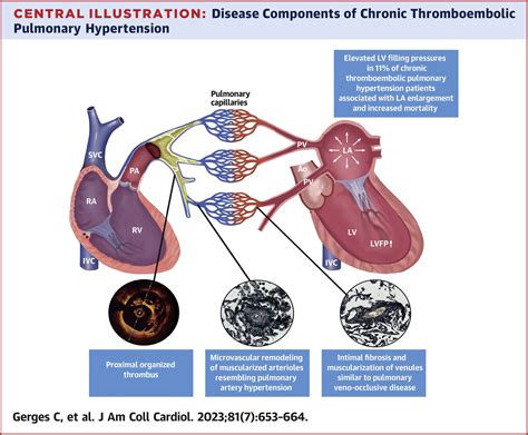 Chronic Thromboembolic Pulmonary Vascular Disease And Left Heart