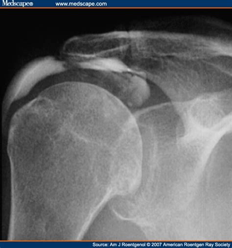 Rotator Cuff Impingement Correlation Between Findings On Mri And Outcome