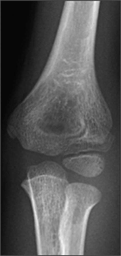 Clinical Practice Guidelines : Lateral condyle fracture of ...