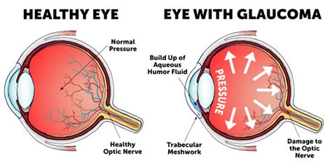 How Can One Differentiate Between Cataract And Glaucoma Axis Eye Clinic