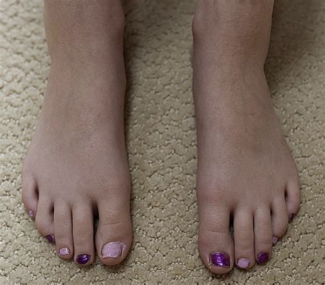 Blue Toes After Stimulant Therapy For Pediatric Attention Deficit