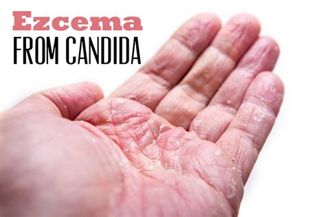 Discover The Eczema And Candida Connection Home Cures That Work