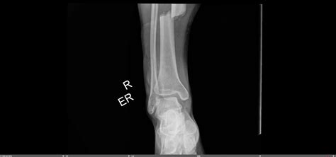 Tibia Shaft Fracture — Chicago Foot And Ankle Orthopaedic Surgeons