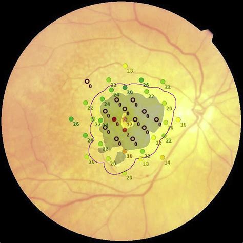 Retinal Sensitivity At The Junctional Zone Of Eyes With Geographic