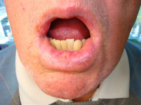 Hormonal imbalance hormonal imbalances during we do not intend to dwell much on lip pimples caused by herpes as we have already discussed much on them. Dermatology For Dentists and Dental Students: Lips
