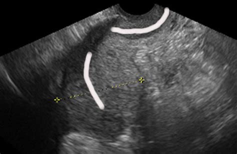 anteverted retroflexed uterus a common consequence of cesarean delivery ajr