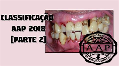 Se quiser se precaver e andar nos trilhos da regularização, continue acompanhando a leitura. Parte 2 Classificação das Doenças Periodontais 2018 ...