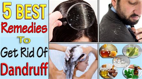 Top 5 Super Effective Remedies To Get Rid Of Dandruff Dandruff Treatment Hair Care Youtube
