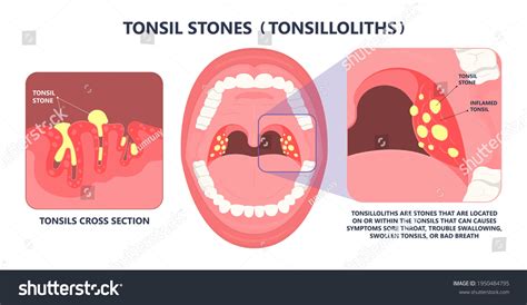 Tonsil Stones Crypts Viral Virus Gland Strep Royalty Free Stock
