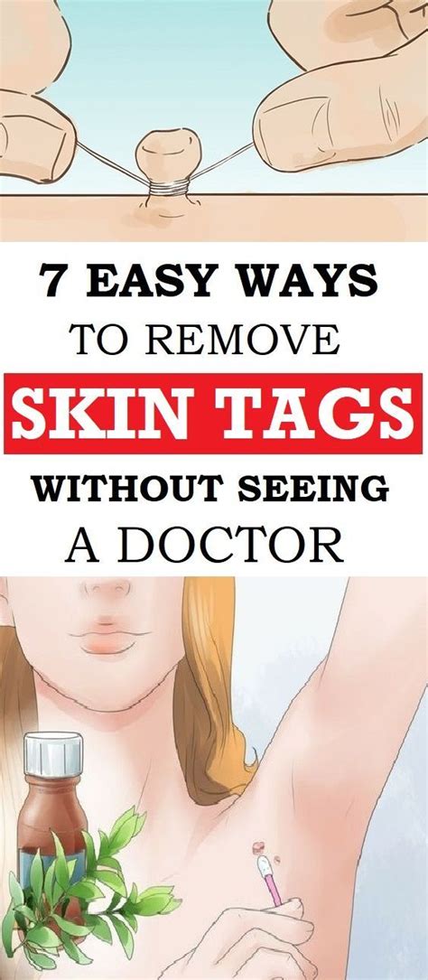 7 easy ways to remove skin tags without seeing a doctor in 2022 skin tag removal natural