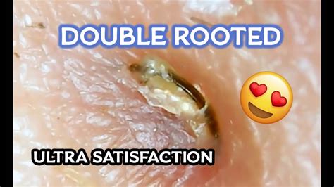 A doctor may prescribe antibiotic ointments, steroid creams. Double Rooted Ingrown Hairs Part #1 (Microscopic) - YouTube