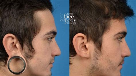 Before And After Picture Of Our Patient Click To Learn More About