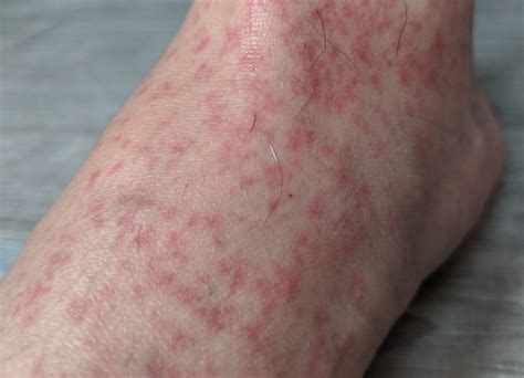 Flat Red Spots On Legs Dermatology Forums Patient