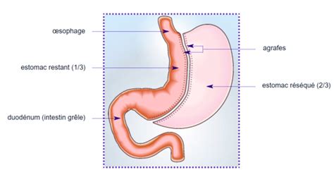 Sleeve Gastrectomie Issue De La Brochure D Information De La HAS Download Scientific Diagram