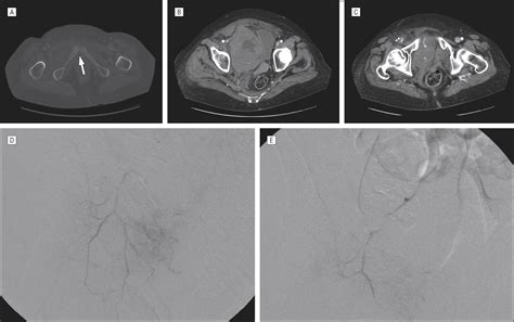 Predictors of Bleeding From Stable Pelvic Fractures | Critical Care