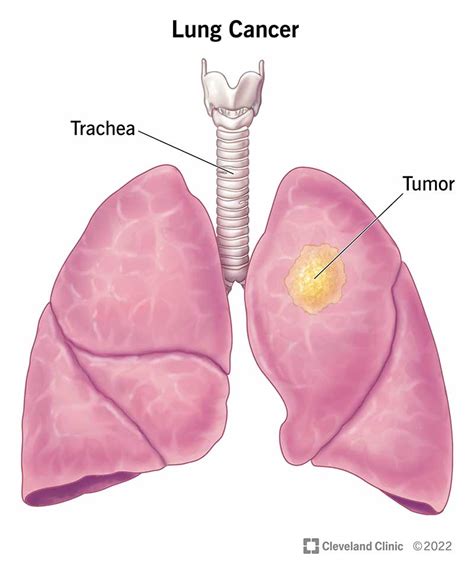 Lung Cancer Types Stages Symptoms Diagnosis Treatment