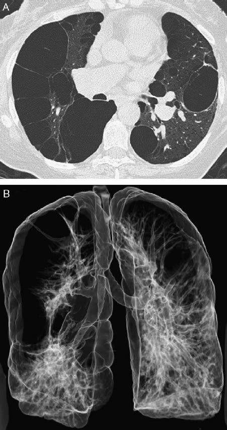 A And B 65 Year Old Female Patient With Vanishing Lung Syndrome Ct