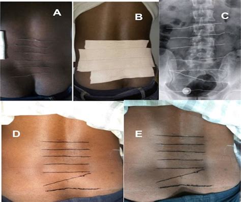 Steps Of Preoperative Skin Marking A Placement Of Steel Wires On