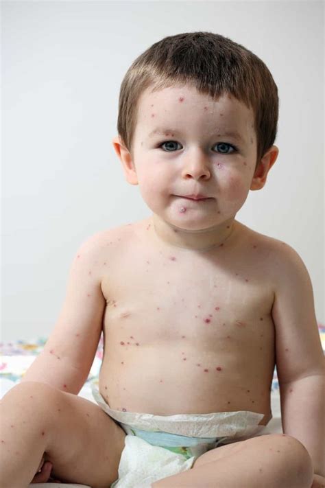 17 Most Common Types Of Baby Rashes With Pictures In 2022 Baby Rash