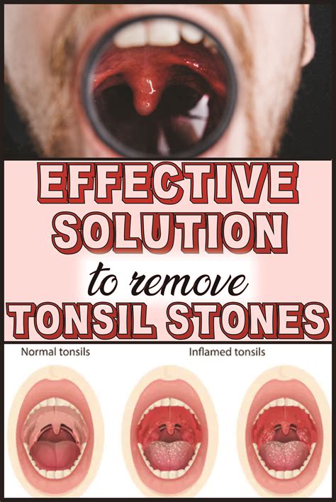 How To Prevent Tonsil Stones Naturally How To Do Thing