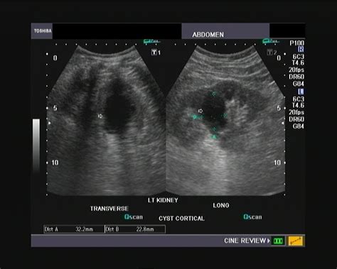 Ultrasound And Color Doppler Videos An Unusual Cortical Cyst Of Kidney